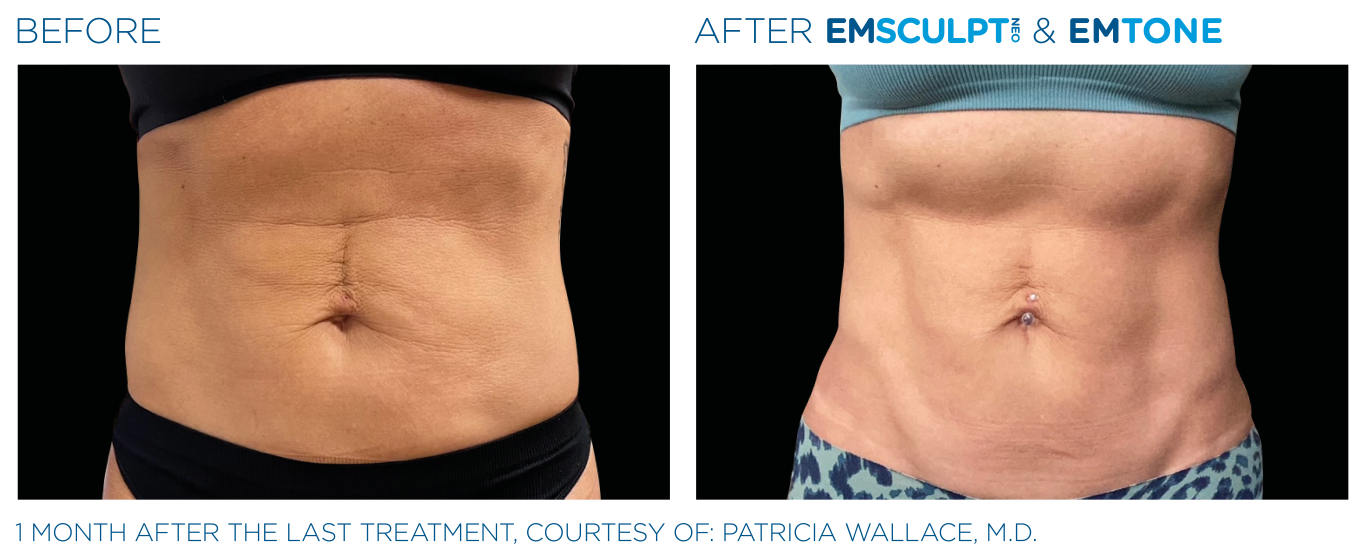 Emsculpt_Neo-Emtone_PIC_Ba-card-female-abdomen-001_ENUS100 (Medium)