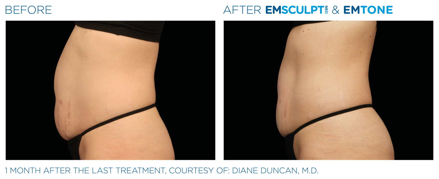 Emsculpt_Neo-Emtone_PIC_Ba-card-female-abdomen-004_ENUS100 (Medium)