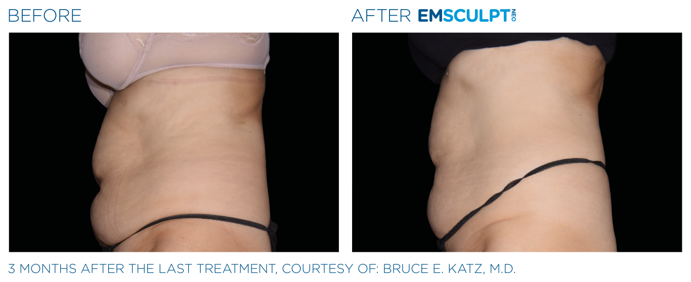 Emsculpt_neo_PIC_Ba-card-female-abdomen-003_ENUS100 (Medium)