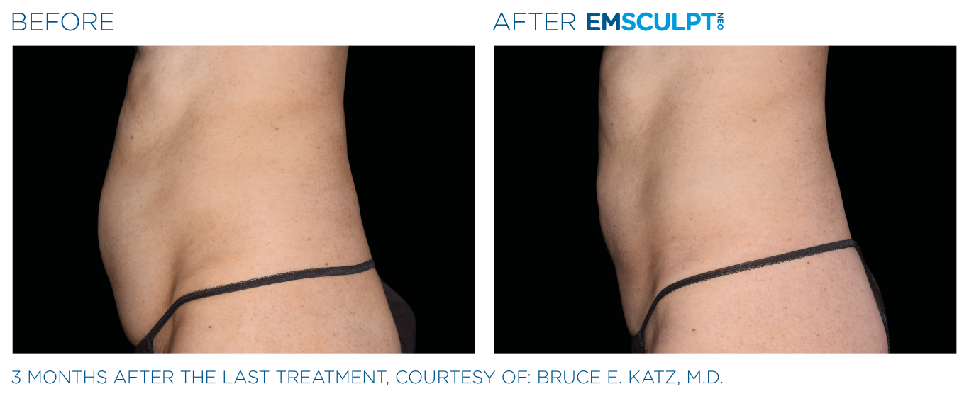 Emsculpt_neo_PIC_Ba-card-female-abdomen-006_ENUS100 (Medium)