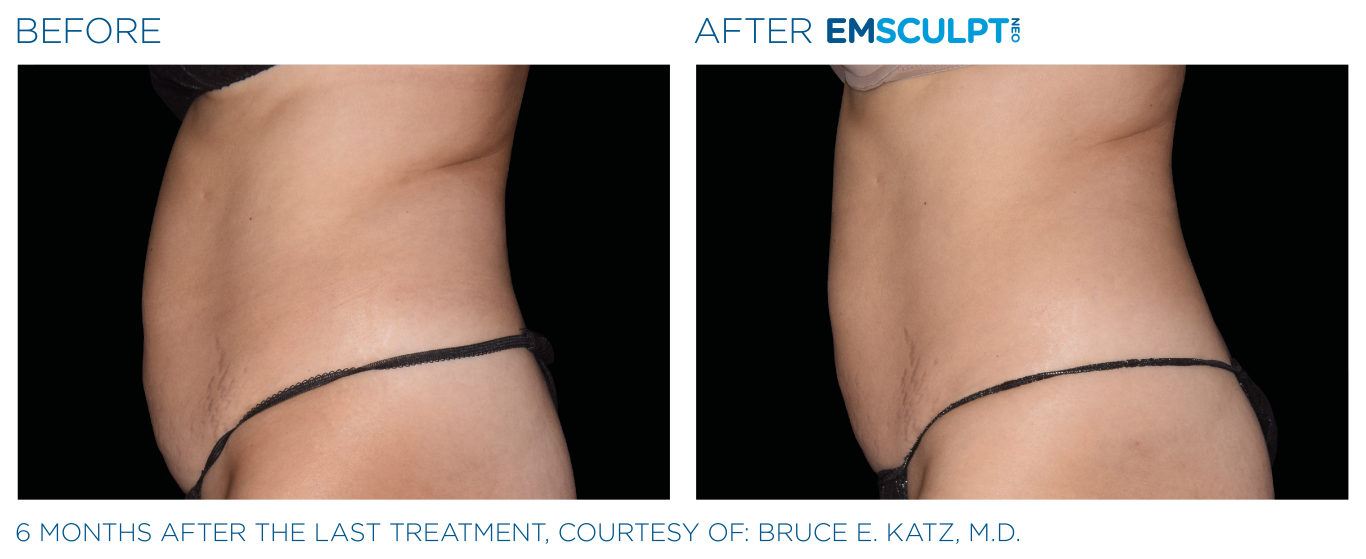 Emsculpt_neo_PIC_Ba-card-female-abdomen-037_ENUS100 (Medium)