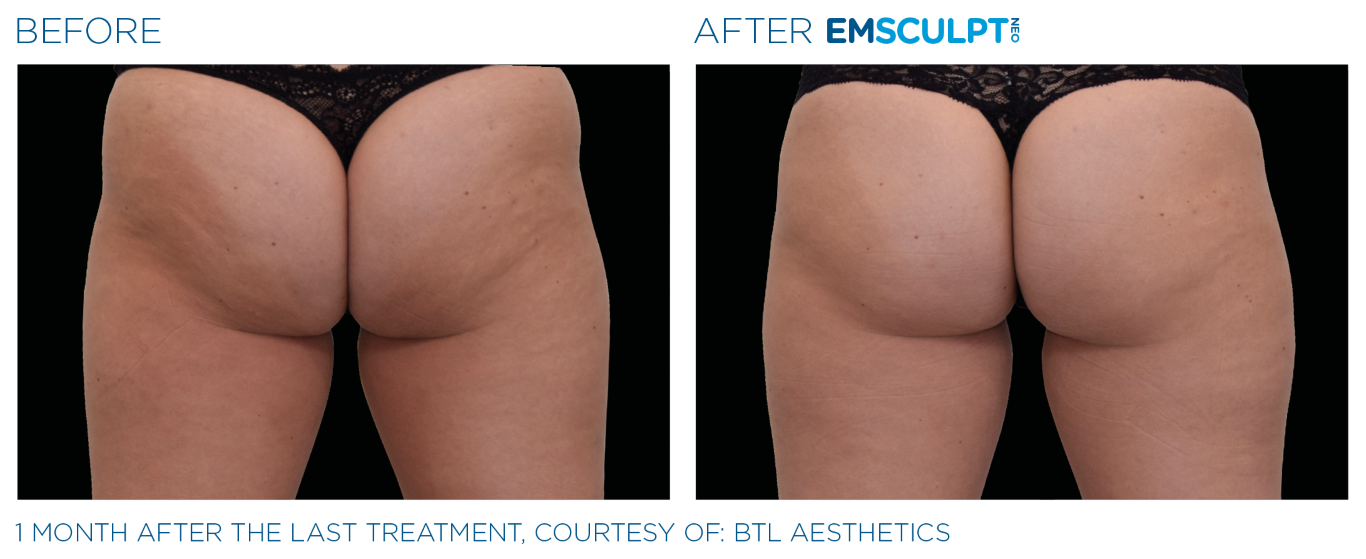 Emsculpt_neo_PIC_Ba-card-female-buttock-061_ENUS100 (Medium)
