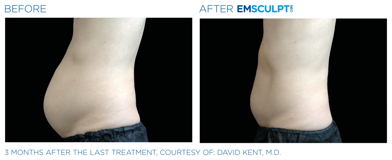 Emsculpt_neo_PIC_Ba-card-male-abdomen-022_ENUS100 (Medium)